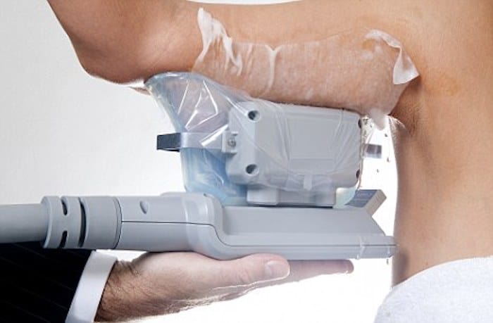 fat freezing arms Henley-on-Thames