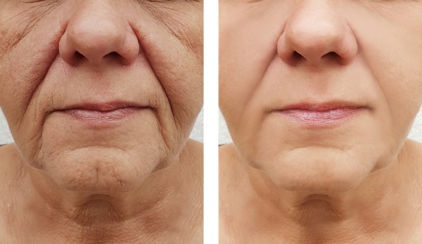 Learn more about Morpheus8 Treatment Henley-on-Thames today!