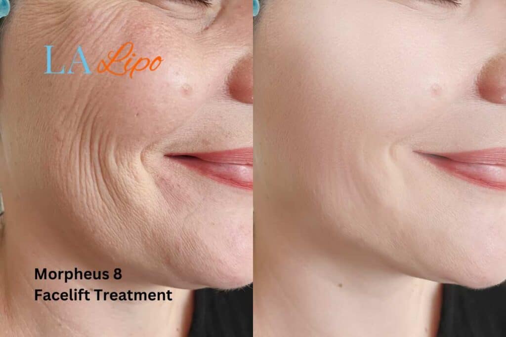 Morpheus8 Treatment Henley-on-Thames for flawless skin! Call us today!
