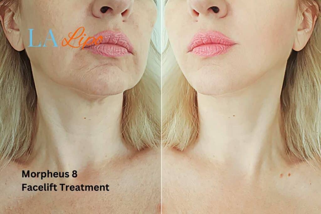 Turn back time with Morpheus8 Treatment Henley-on-Thames