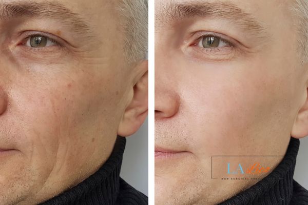 See the amazing results of Morpheus8 Treatment Henley-on-Thames!